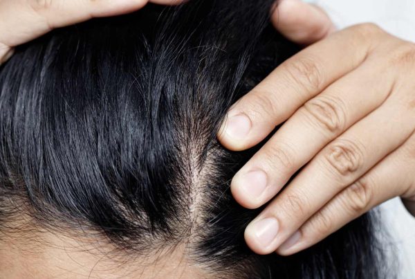 Hair Loss treatments